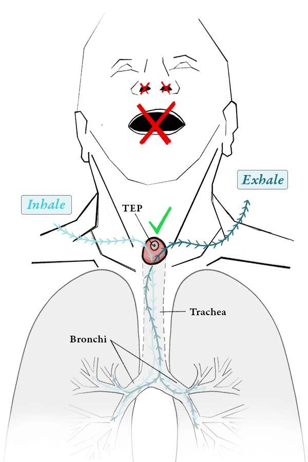Illustration of a laryngectomy patient and how breathing is achieved through the stoma into and not the mouth or nose.