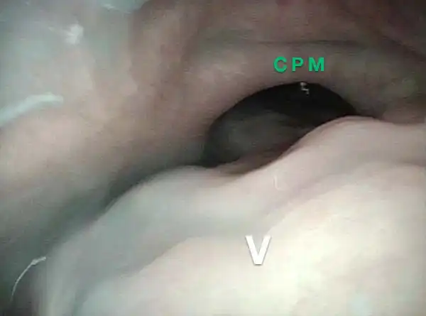 Partially open esophagus due to A-CPD