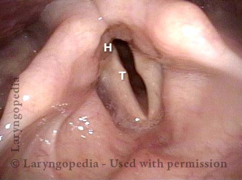 Large gap between vocal cords during phonation