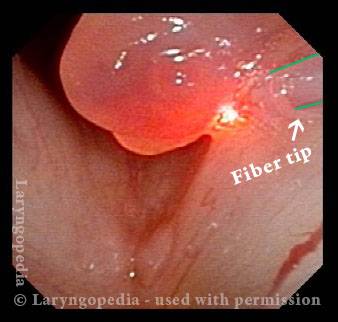 laser removal of hemorrhagic polyp
