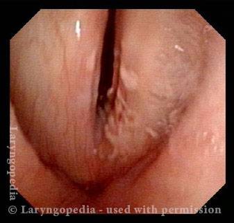 Voice instantly improves after removal of polyp