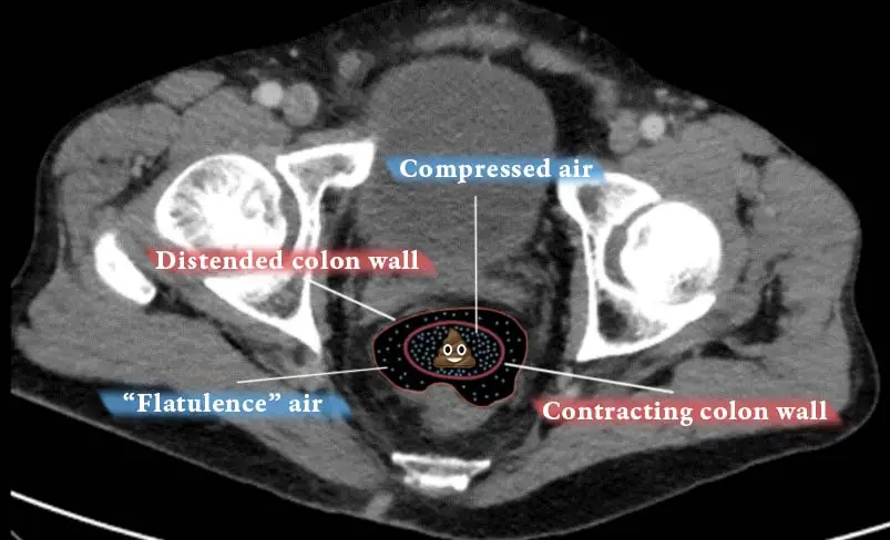 CT scan of dilated rectum filled with air