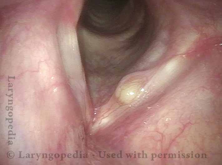 Mucus retention cyst on left vocal cord