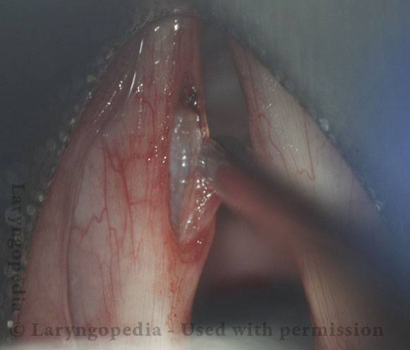 Dissection of mucus retention cyst continues