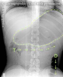 x-ray of Abdominal Distention from R-CPD