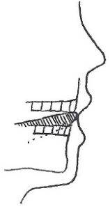 Place tongue tip between front teeth and gently bite down to hold in place. Swallow your saliva. Feel the back of your tongue move.