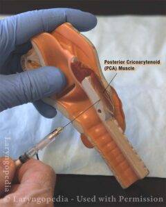 model demonstrating AB-SD Injection into PCA Muscle