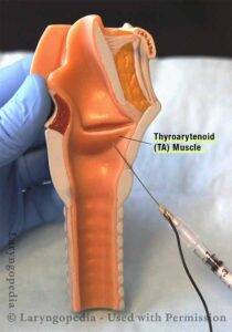 model demonstrating AD-SD Injection into TA Muscle