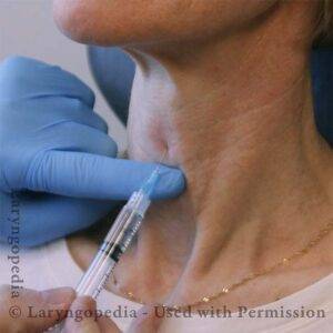 Lidocaine Injection for SD Botox Injections