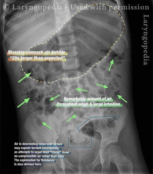 x-ray of a four year old showing severe bloating in the chest and abdomen due to R-CPD (inability to burp)