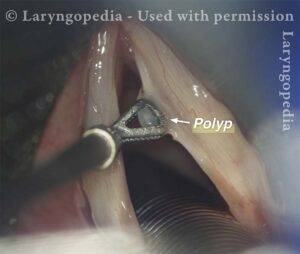 Microsurgical Removal of Polyp on a singers vocal cord