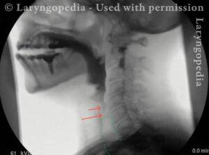 Above the sphincter is the head of the barium bolus
