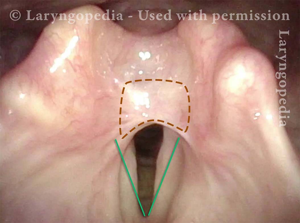 Supraglottic stenosis