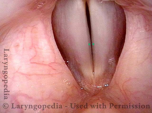 With phonation, the characteristic vibratory blur appears as a thin grey blur band