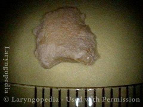 Expectorated sequestrum