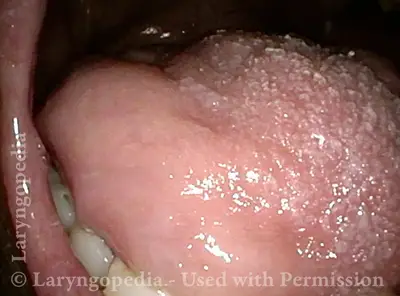 Tongue Fasciculation