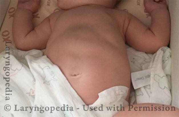 Infant with R-CPD